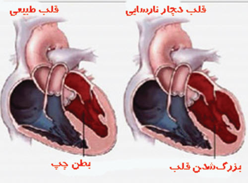 نارسايي قلبي